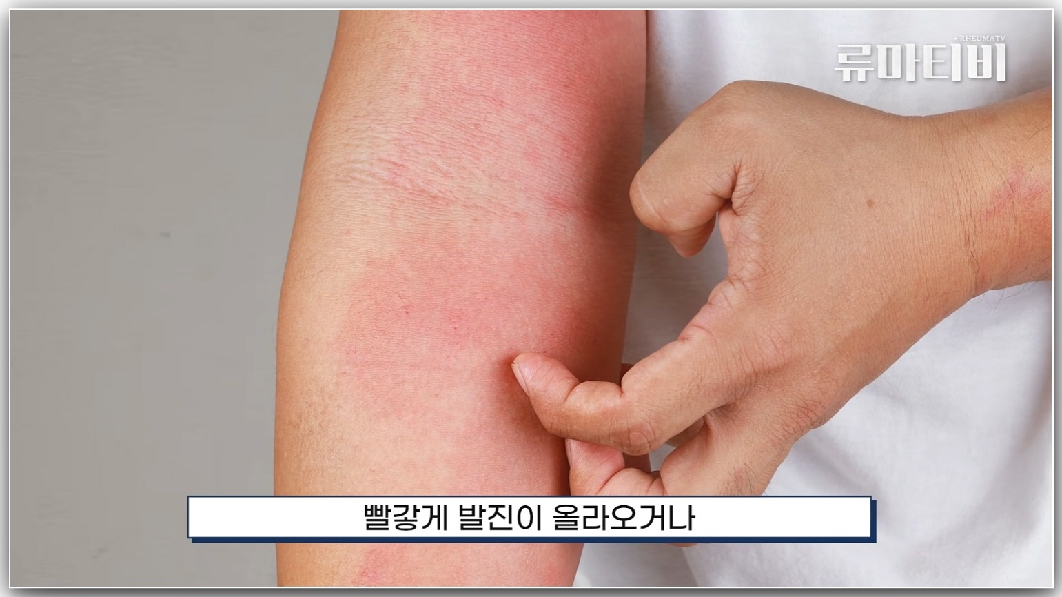 붉은 피부 발진 증상, 가려움증 이미지