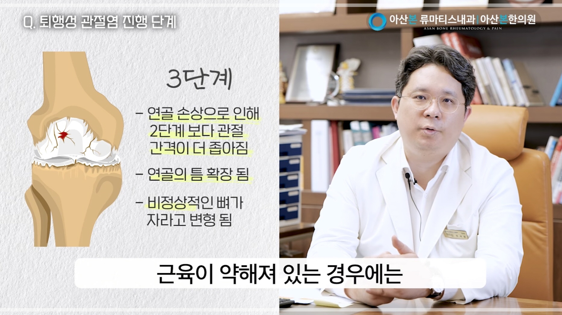 무릎 퇴행성 관절염 3단계 증상과 상태를 설명하는 아산본내과 의료진