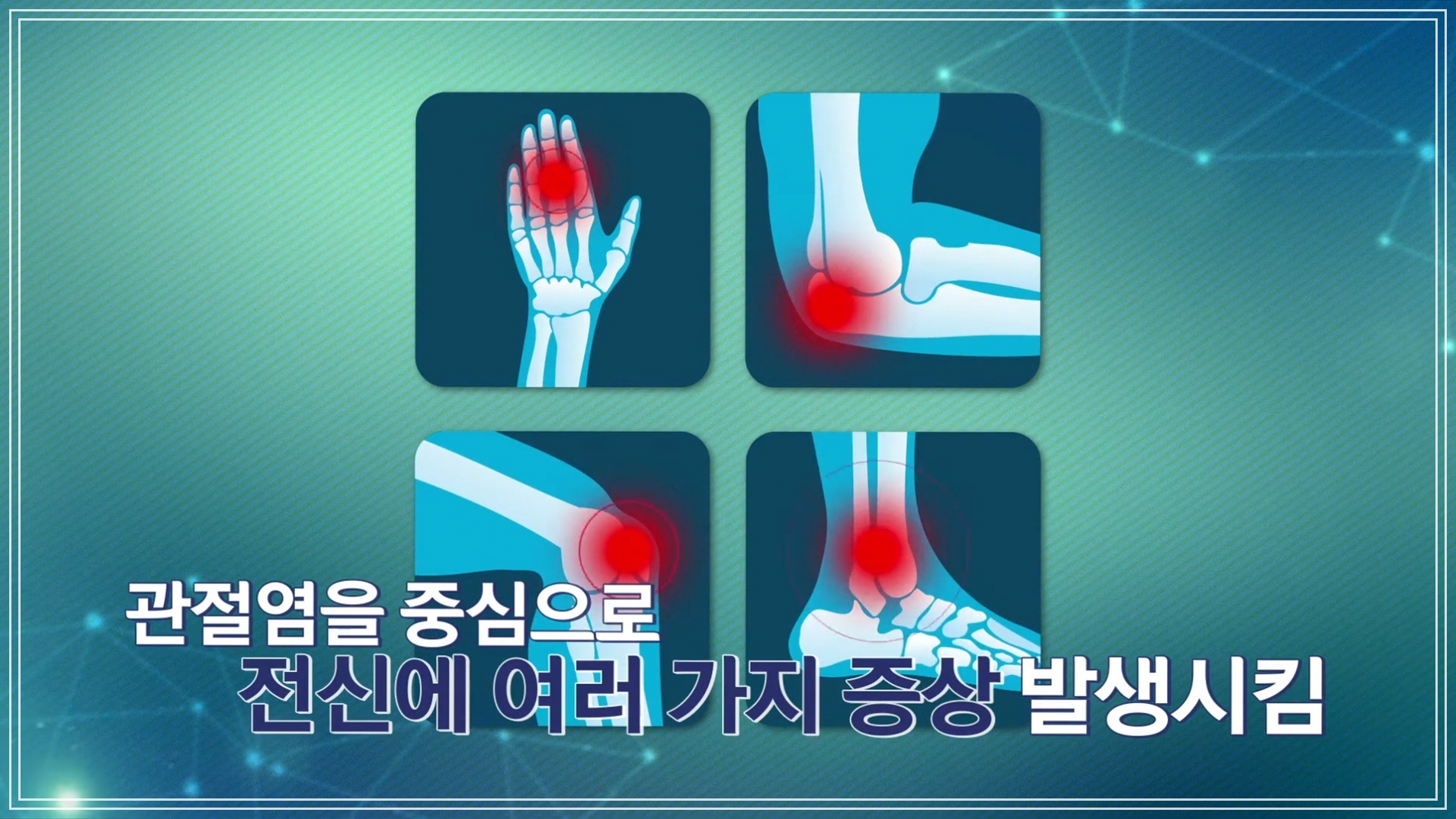 류마티스 관절염 증상 설명