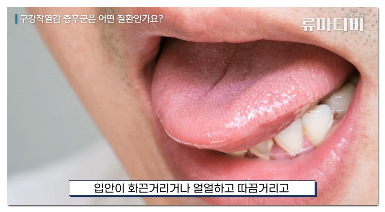 혀가 뜨거워요, 구강작열감증후군 원인과 증상 진단