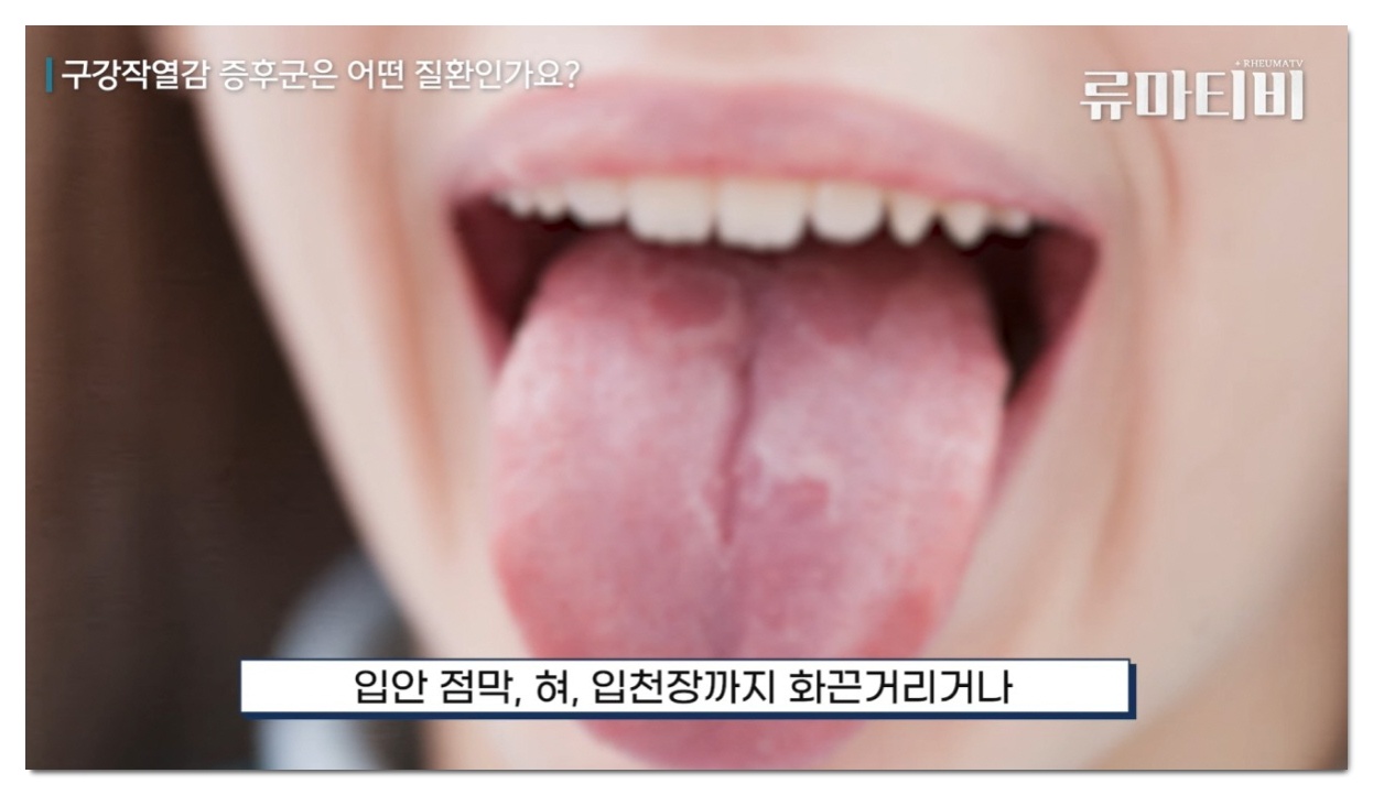 혀가 뜨거워요, 자가면역질환 및 전신 만성통증 내과 치료