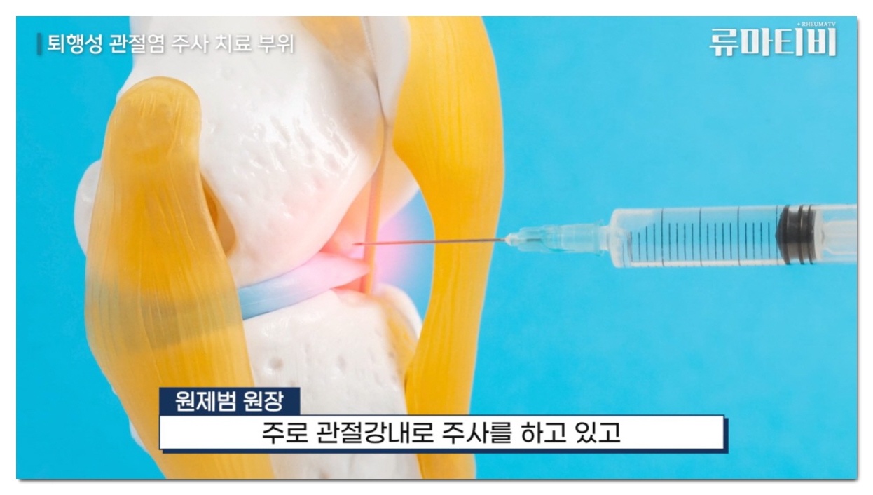 무릎구부릴때 통증, 계단 내려갈 때 무릎 통증 치료