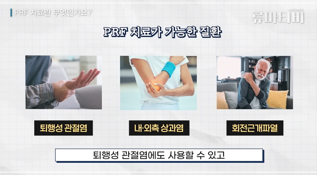 무릎 통증 치료 방법 중 하나인 PRF의 적용 범위