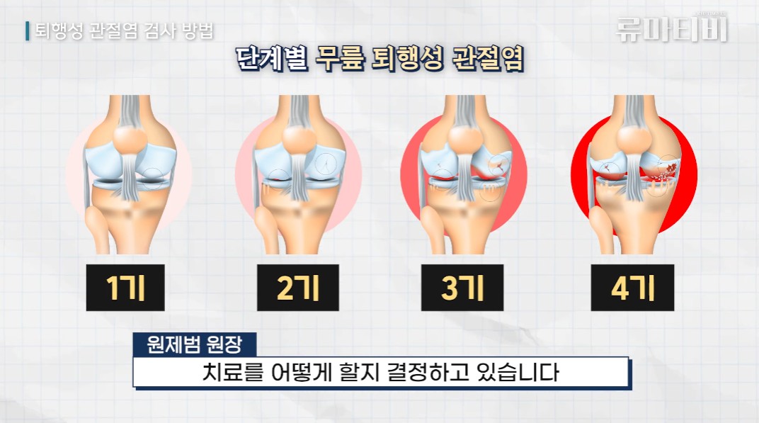 퇴행성 관절염 시기별 증상 무릎 통증