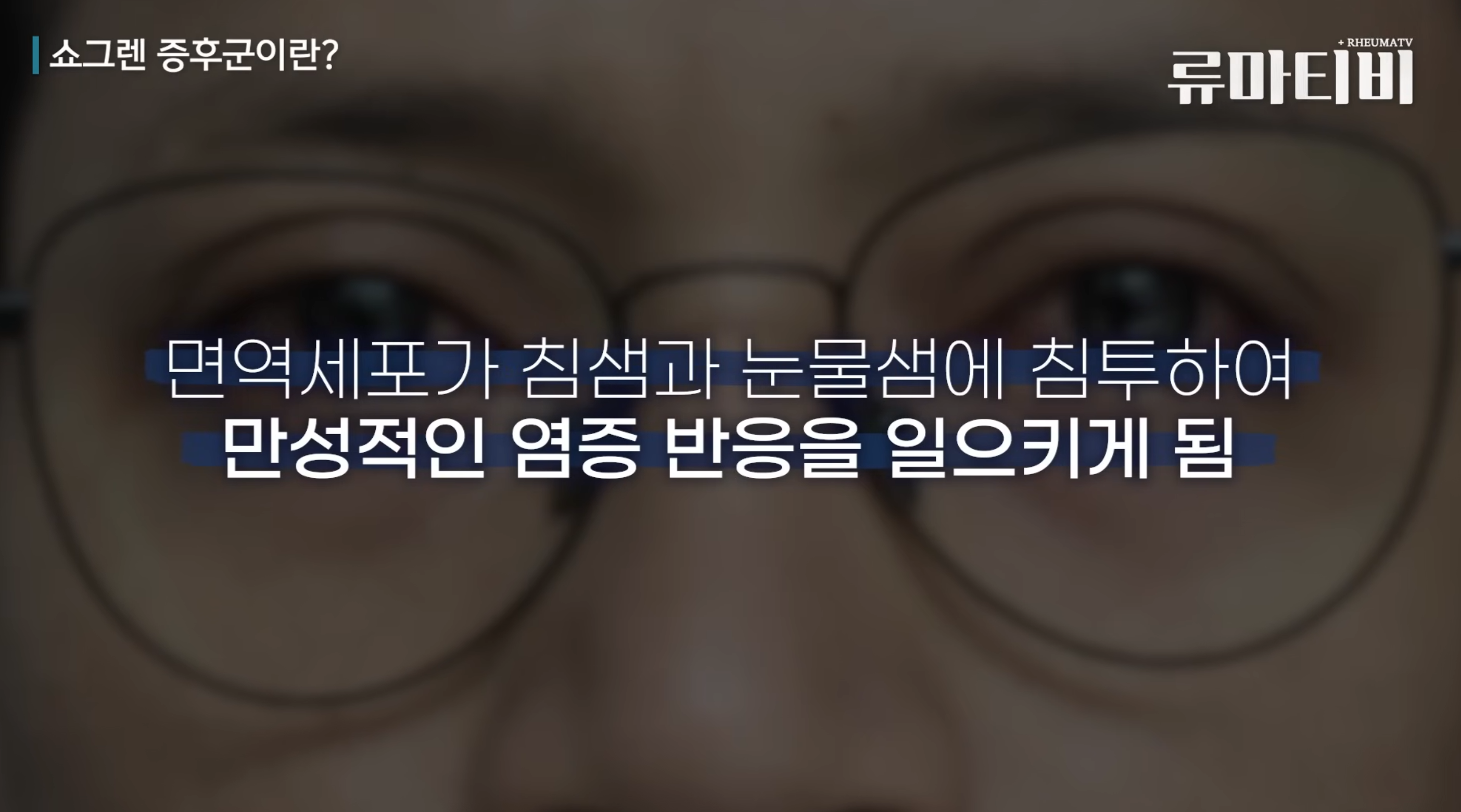 쇼그렌 증후군의 개념 설명 - 쇼그렌 증후군이란? 면역세포가 침샘과 눈물샘에 침투하여 만성적인 염증 반응을 일으키게 됨