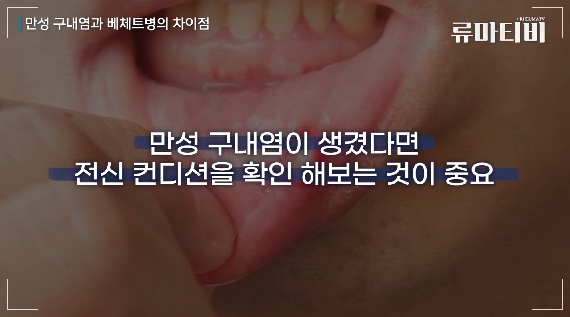 잦은 구내염 원인? 베체트병 대표 증상 TOP5 아산본내과의원에서는 전신 컨디션을 확인합니다