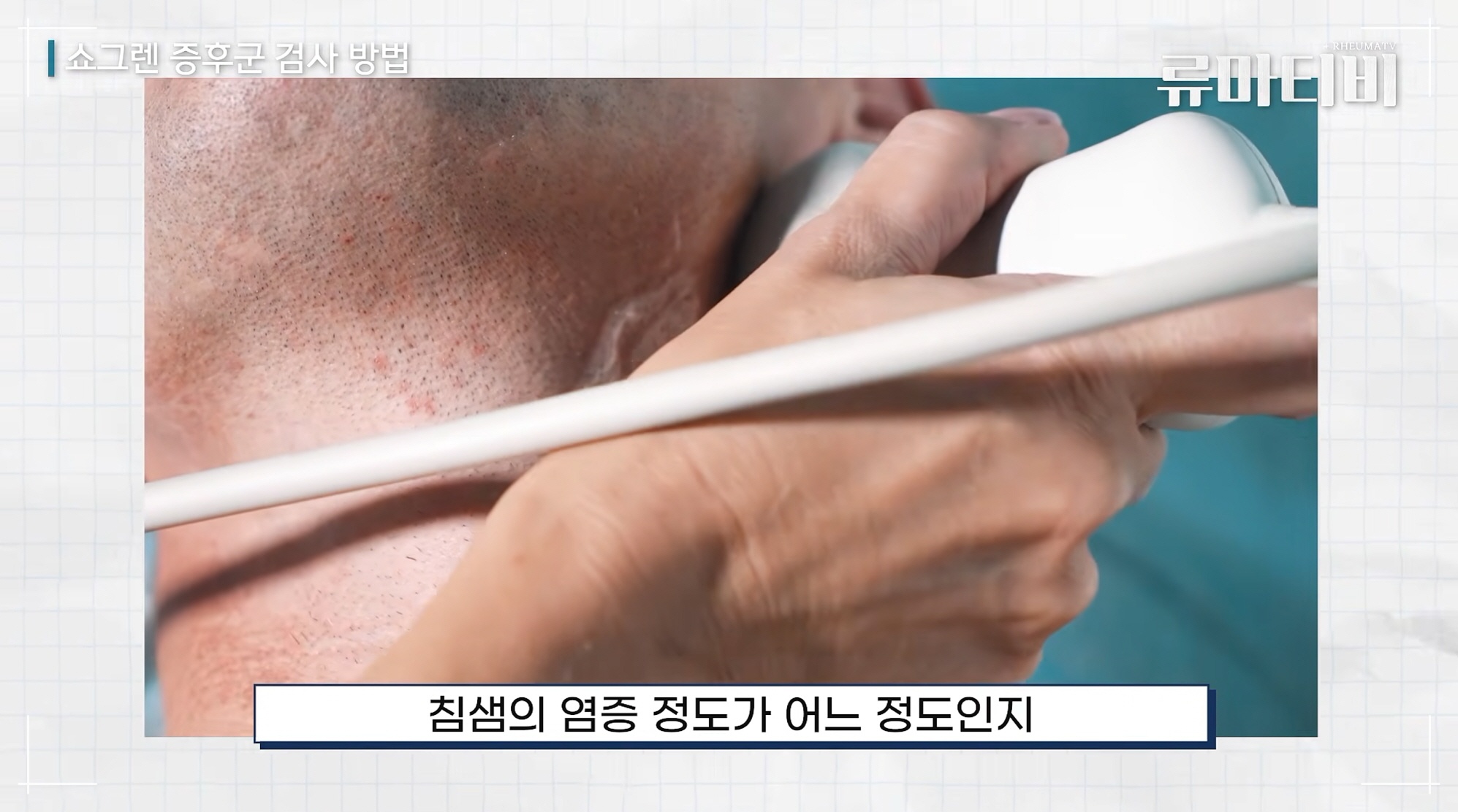 안구건조증 해결 위해 쇼그렌증후군 진료과 아산본내과의원이 진행하는 침샘 초음파 검사
