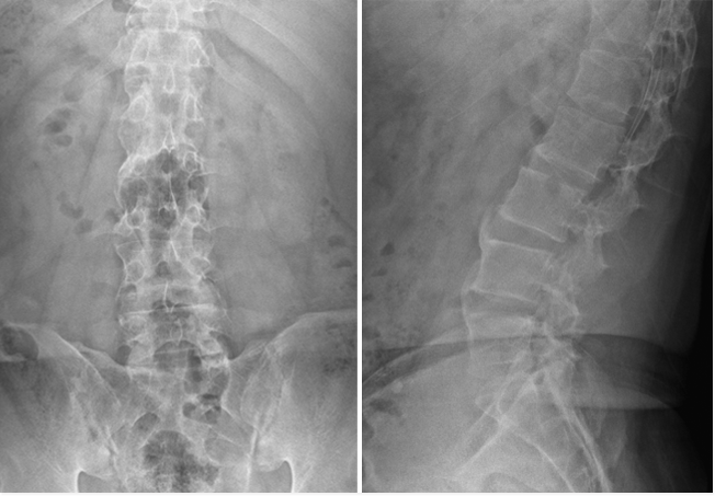 강직성 척추염 X-ray 사진